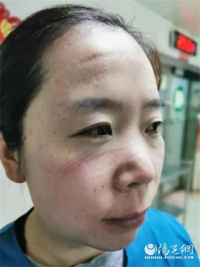 隔离区寻踪：揭秘淤青脸的终极攻略指南