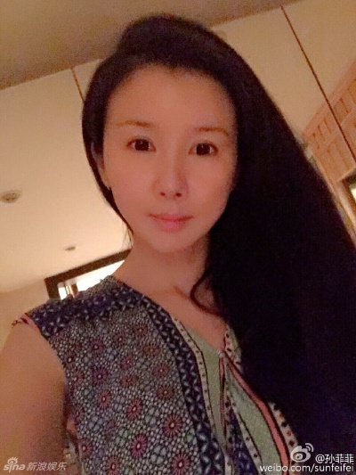 孙菲菲整容失败复盘,面部僵硬与馒化如何修复? 孙菲菲整容失败复盘,面部僵硬与馒化如何修复?