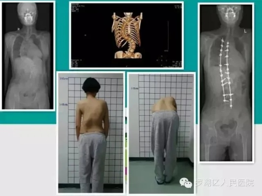 脊柱侧弯矫正后长高21厘米？这类患者才有希望